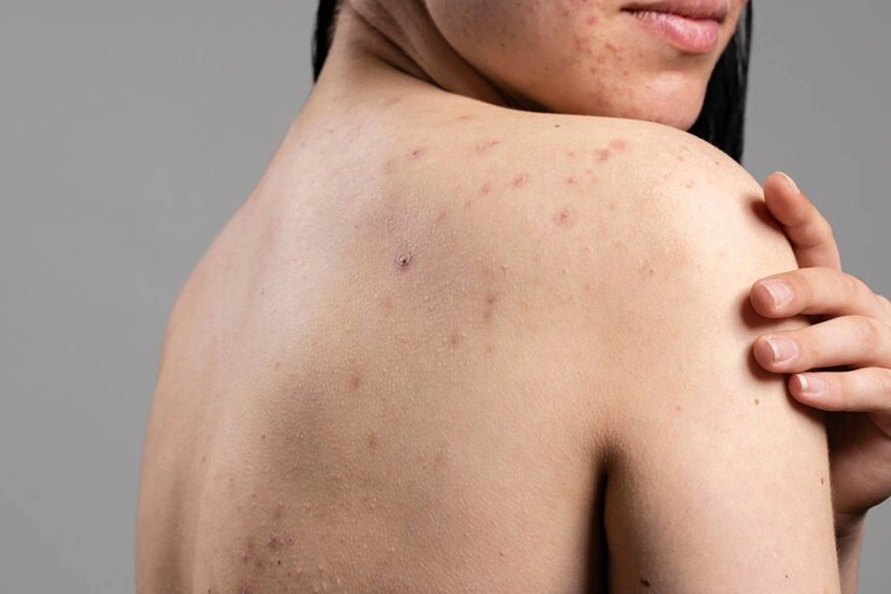 Oily-Skin Oily Skin