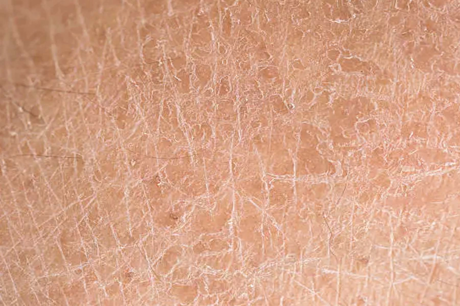 Dry body skin