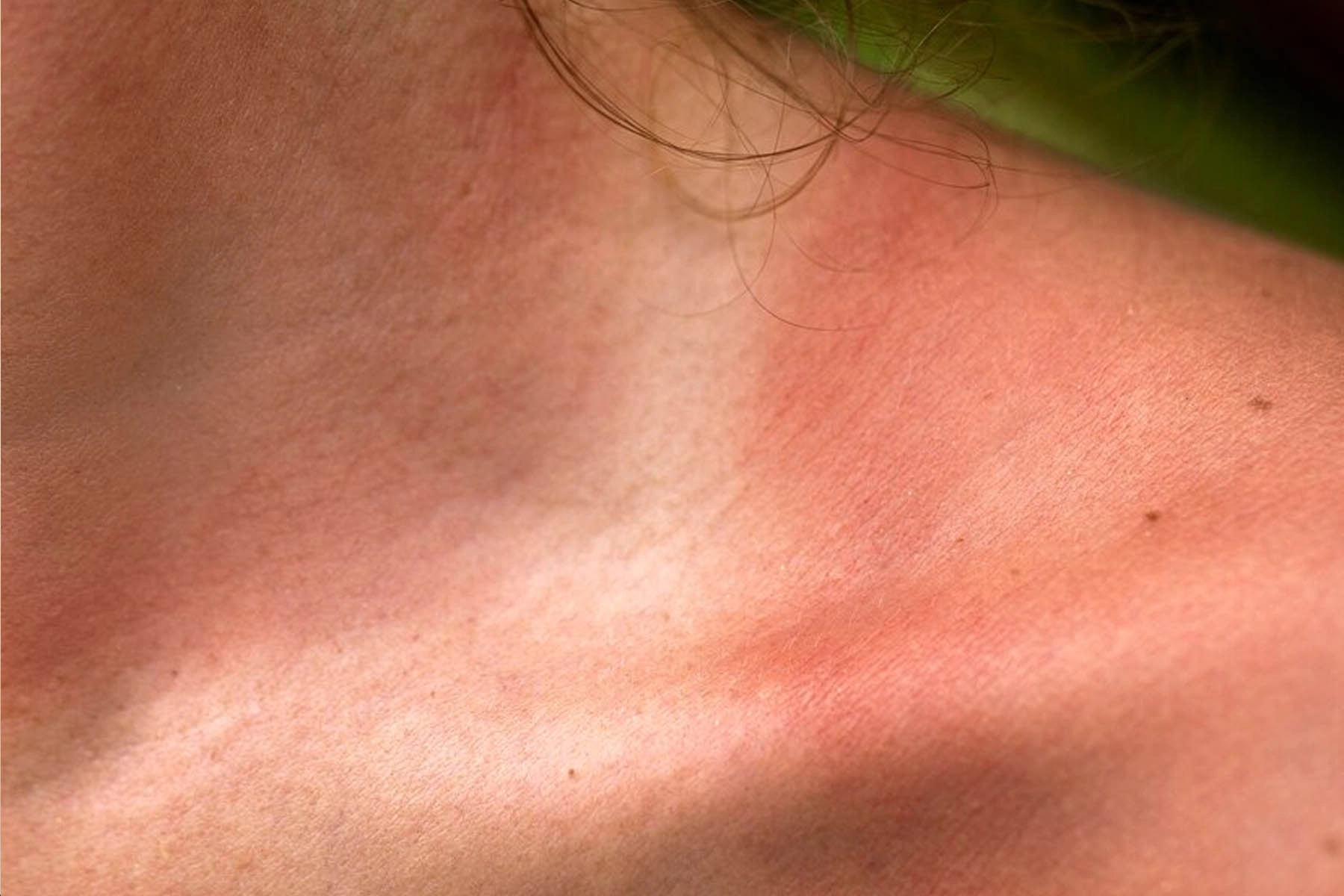 Sensitive-Skin Sensitive Skin