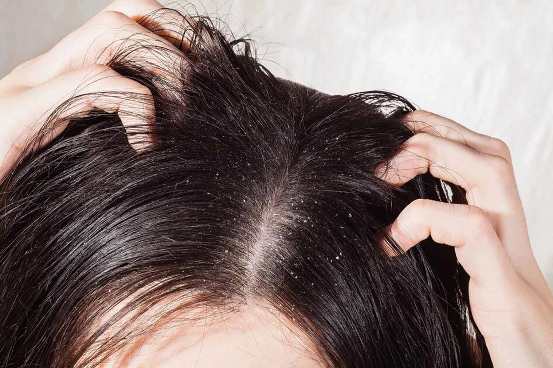 Oily-Hair Oily Hair