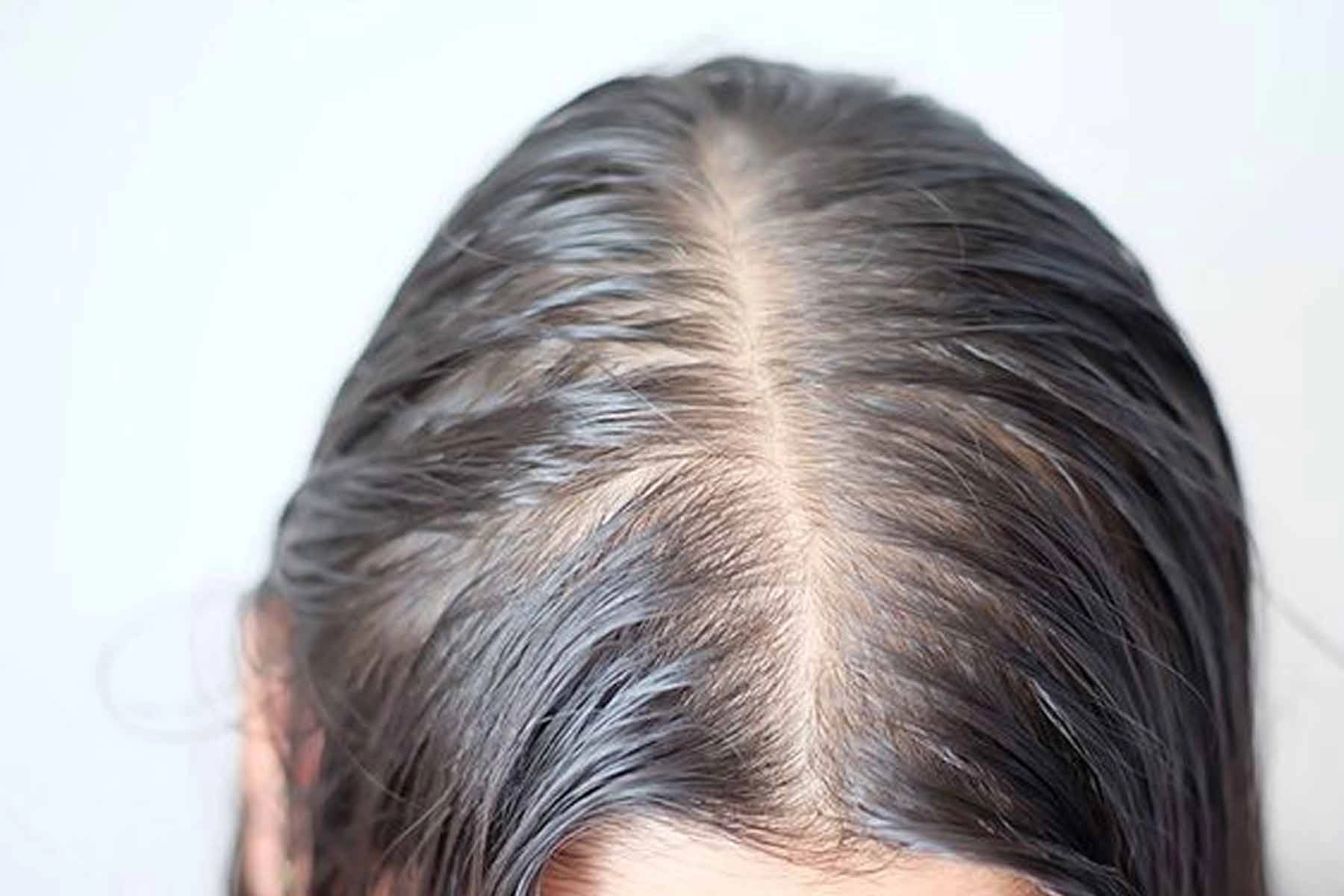 Hair-loss Hair loss