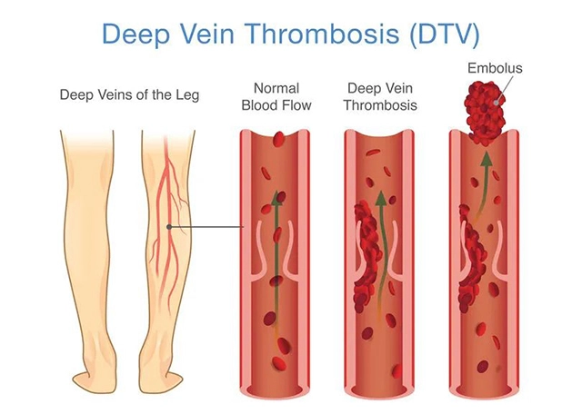 Deep Vein Thrombosis (DVT)