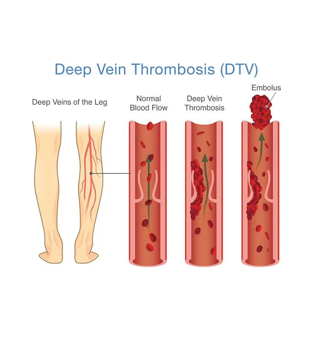 Deep Vein Thrombosis (DVT)