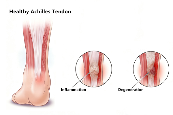 Achilles Tendon