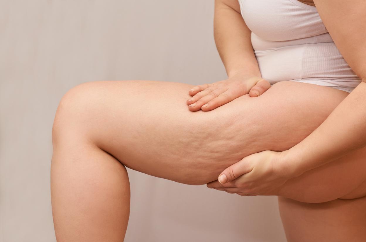 Cellulite Leg Skin