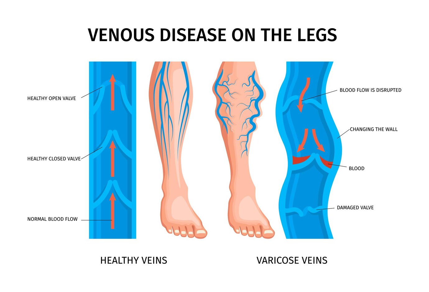 Deep Vein Thrombosis