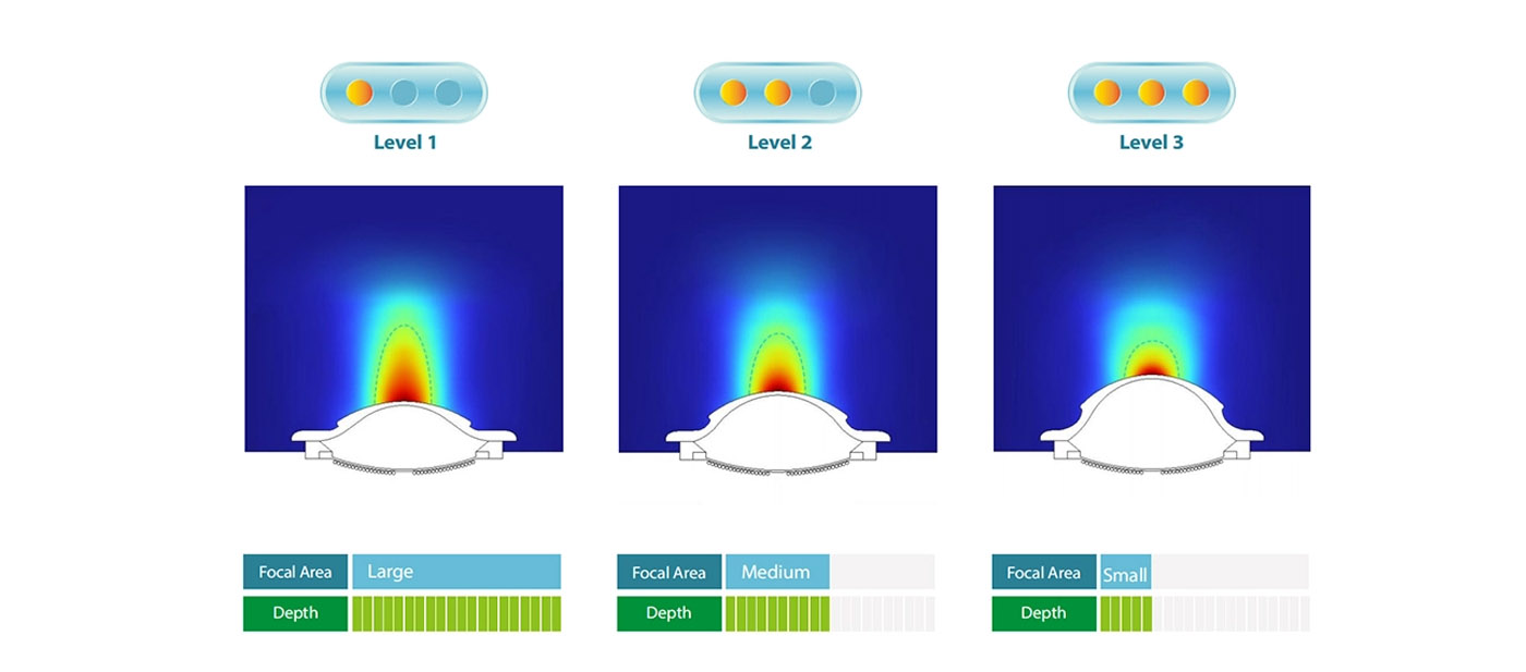 Focused Shock Wave Therapy (1)