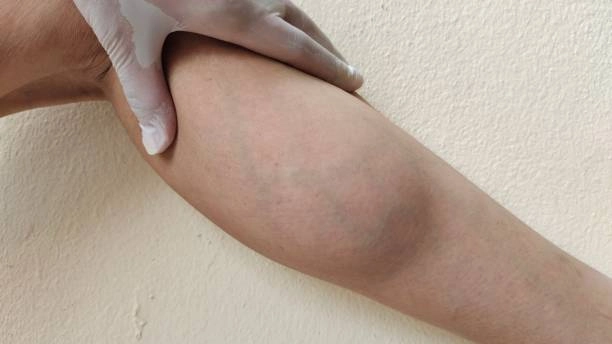 lipedema-symptoms lipedema symptoms