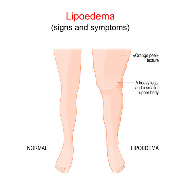 signs of  lipedema