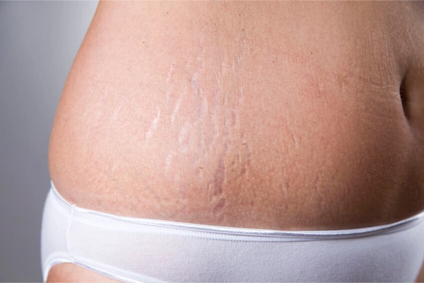Smooth-Stretch-Marks-with-Advanced-Shockwave-Therapy-Devices Smooth Stretch Marks with Advanced Shockwave Therapy Devices