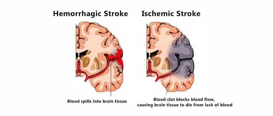 world stroke day world stroke day