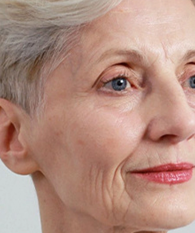 Facial laxity