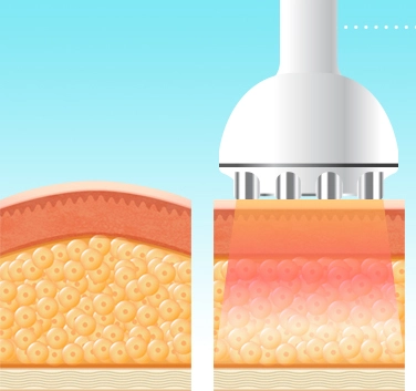 3 in 1 cavitation machine