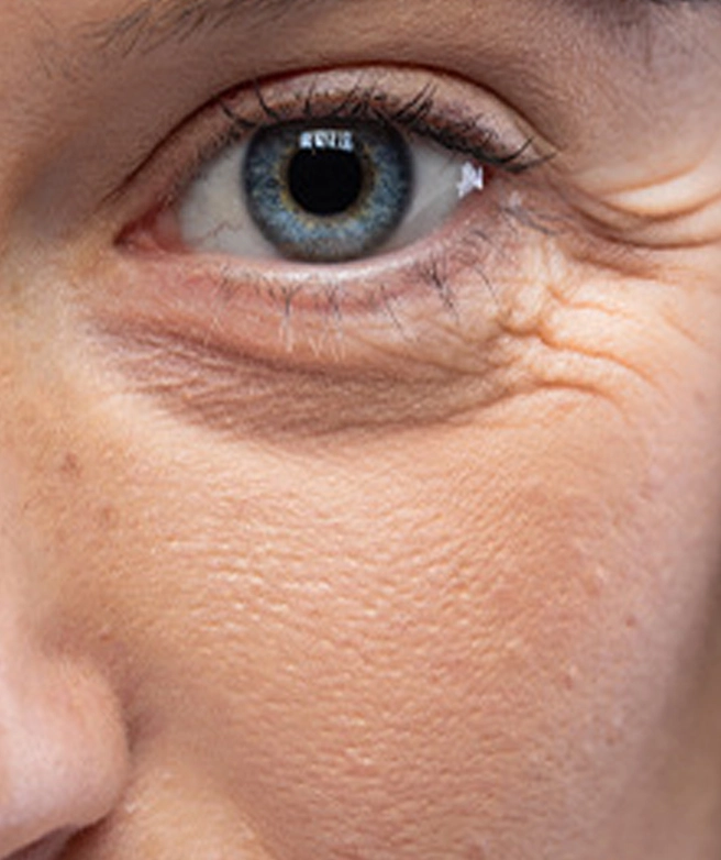 Fine lines around the eyes