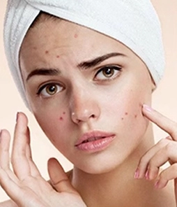 LONG ACNE