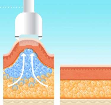 80k rf cavitation machine