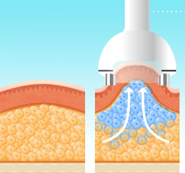 airblasters cavitation machine
