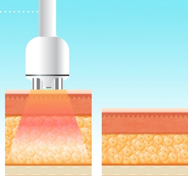 before and after cavitation machine
