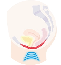 best-hair-laser-removal-machine best hair laser removal machine