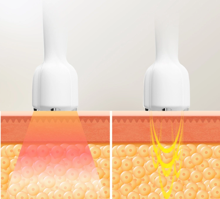best-nd-yag-laser-hair-removal-machine best nd yag laser hair removal machine