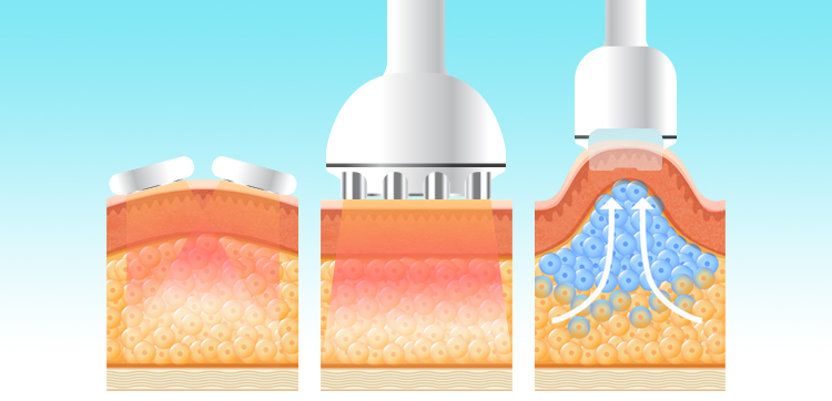 cavitation machine amazon