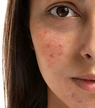 cost of hydra facial machineq