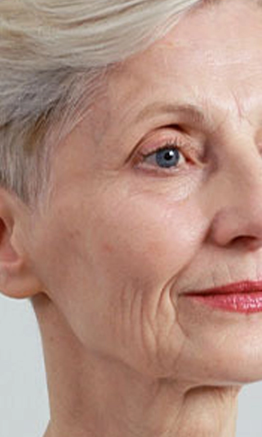 Facial laxity