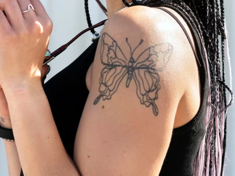 Tattoo Removal
