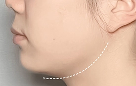 face cavitation machine