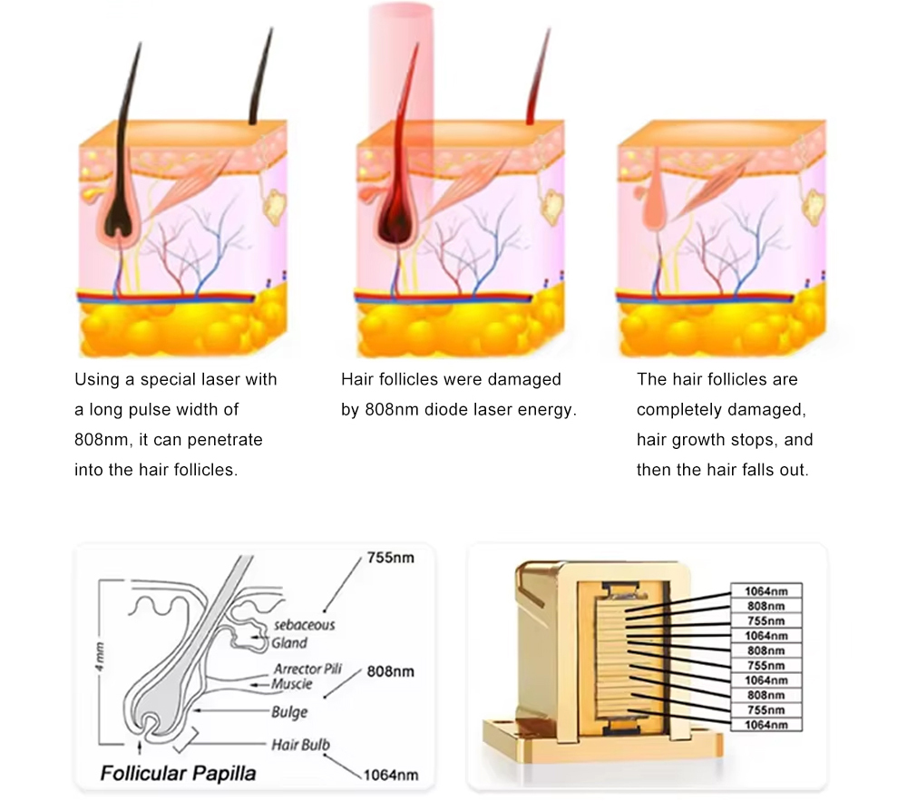L6 laser hair removal machine 44 L6 laser hair removal machine 44