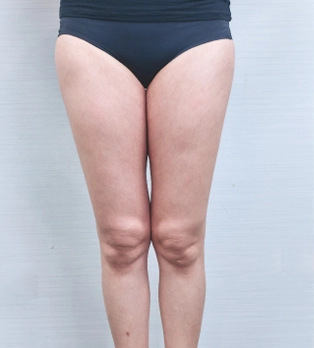 laser lipo cavitation machine