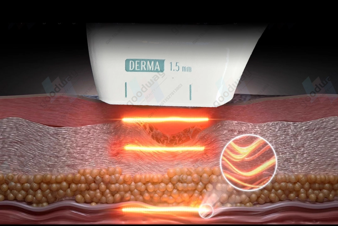 microneedle-rf-machine microneedle rf machine