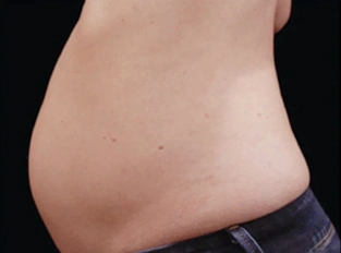 ultrasonic-cavitation-machine-reddit ultrasonic cavitation machine reddit