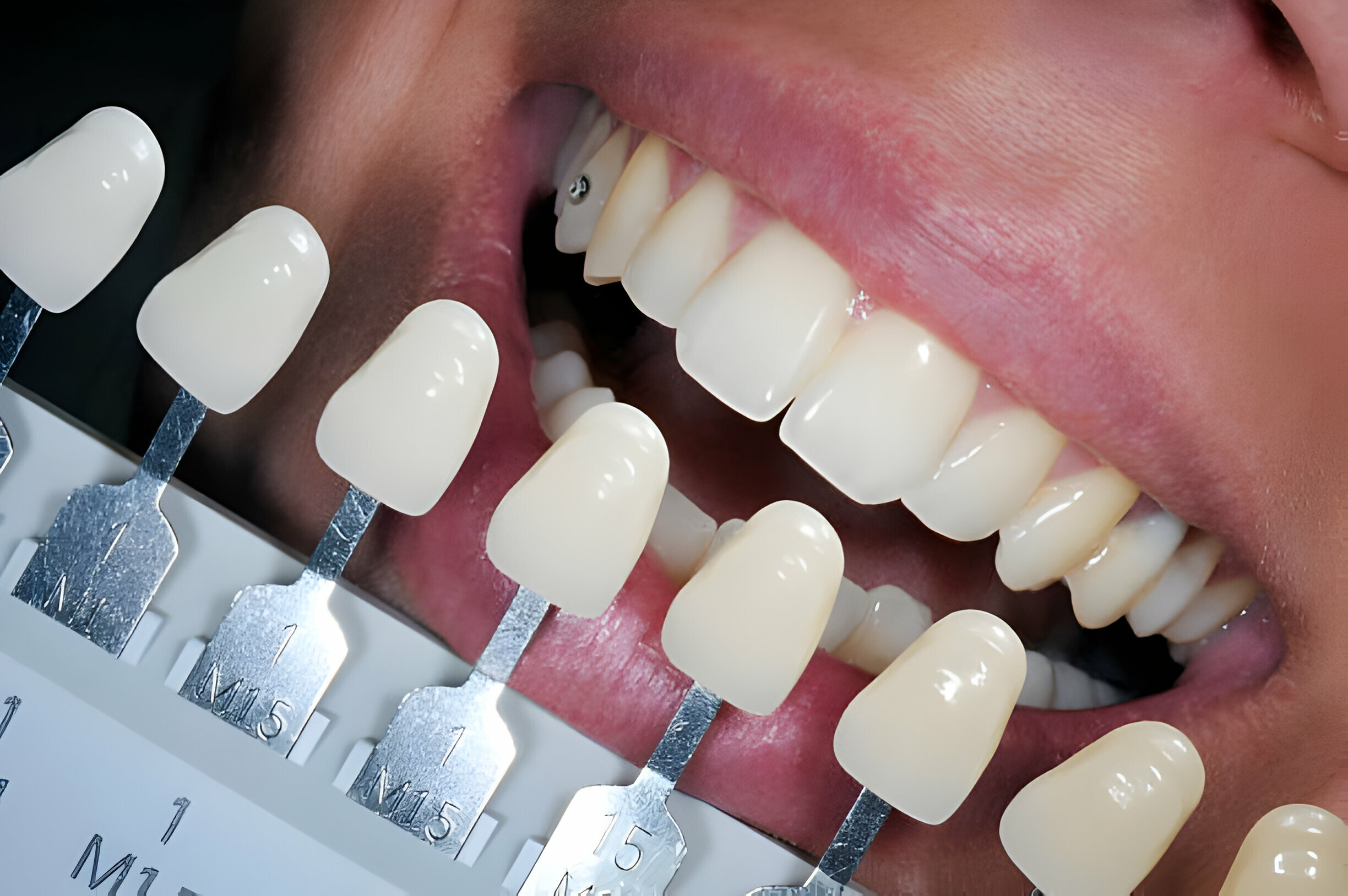 A close-up of a person's teeth with a shade guide next to them.