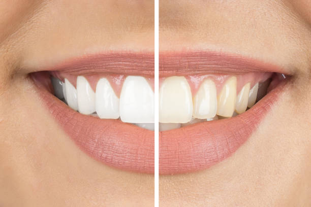 Best quick teeth whitening products deliver stunning results effortlessly.