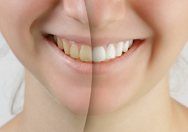 Best teeth whitening pens are a convenient way to maintain your bright smile wherever you are.