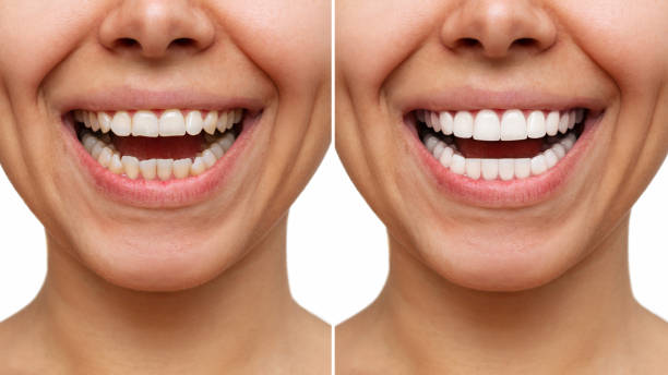 Best whitening for sensitive teeth ensures brighter, whiter teeth with ease.