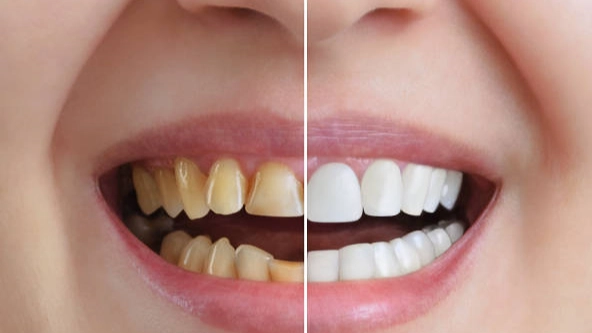 Antes e depois: Os melhores produtos de clareamento rápido para um sorriso mais brilhante.