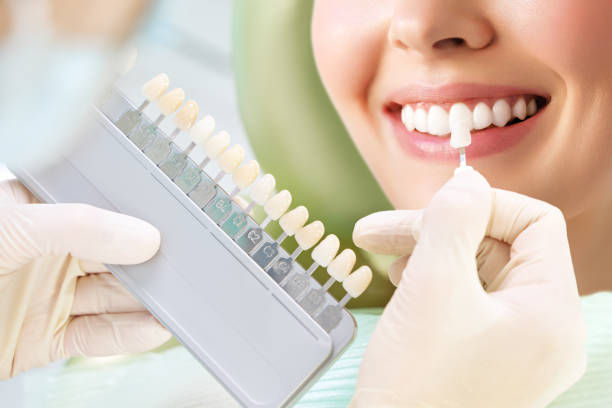 Best teeth whitening for sensitive gums.  Shade guide shows options.