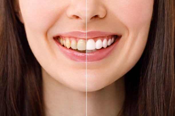 Tooth color change using best teeth whitening strips