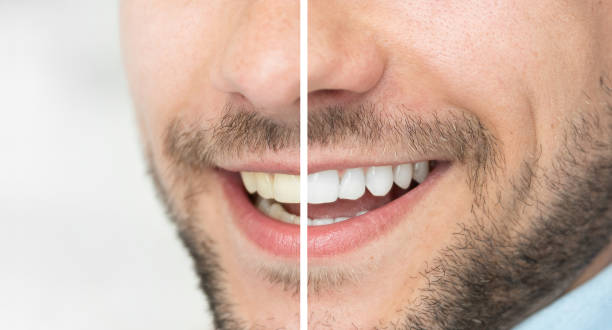 The best and cheap teeth whitening products give you the results you want without breaking the bank.