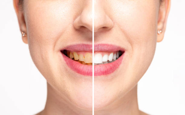 Wholesale teeth whitening products allow retailers and salons to offer effective whitening solutions at competitive prices.