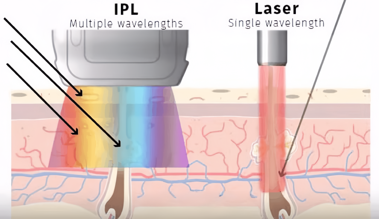 IPL vs Laser