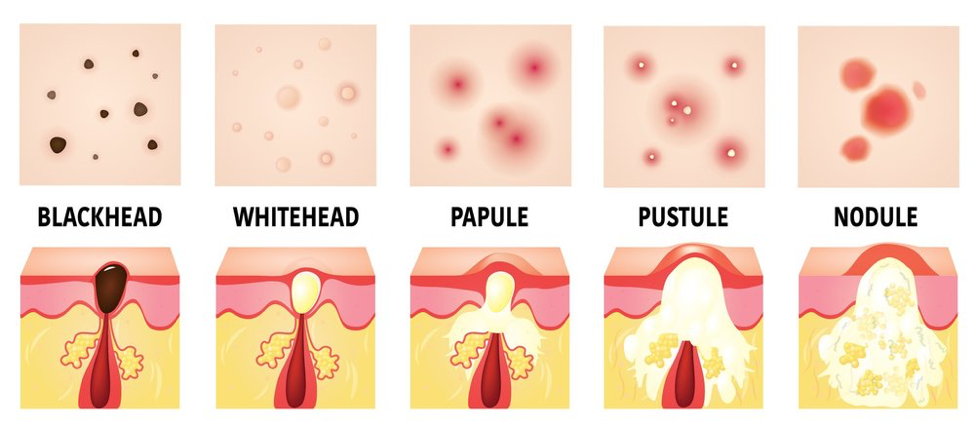 Types of Acne