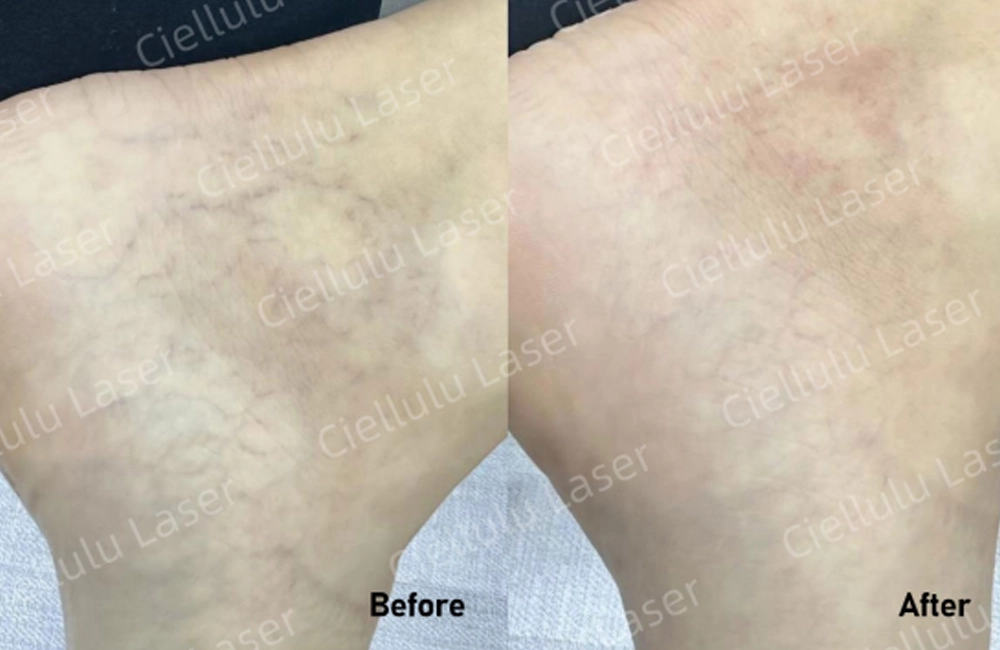 reduce the appearance of the veins