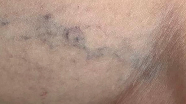 Tratamiento de lesiones vasculares en el brazo antes de la cirugía (600 x 500 px) Tratamiento de lesiones vasculares brazo antes 600x500px