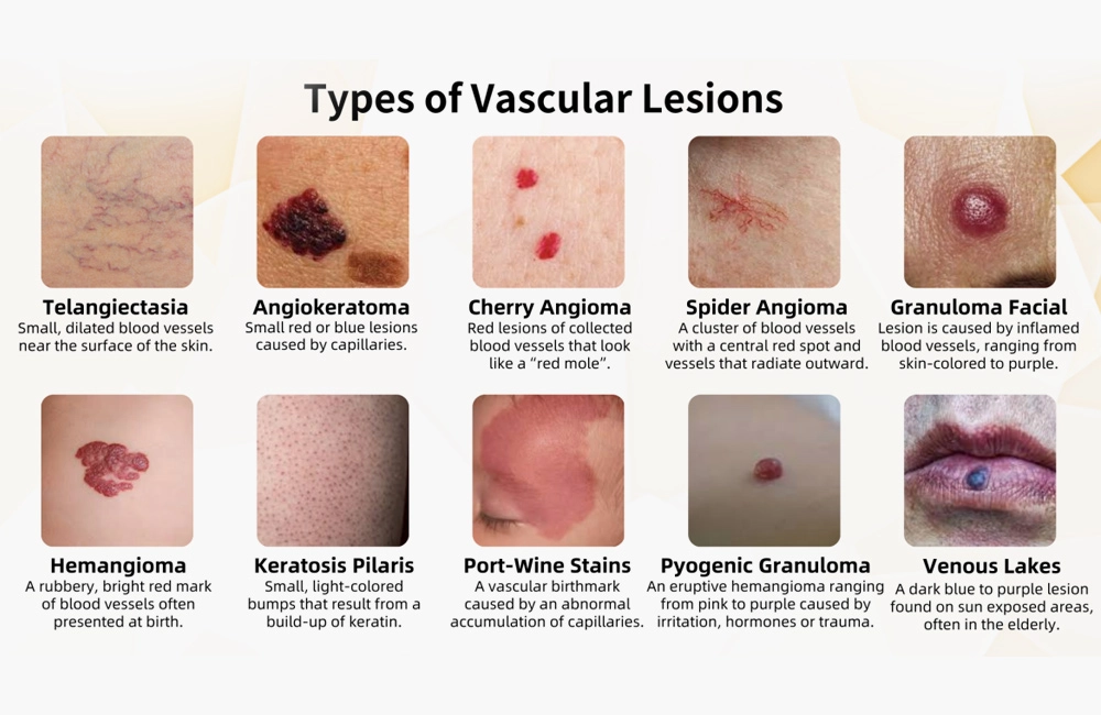 Types & Causes of Vascular Lesions