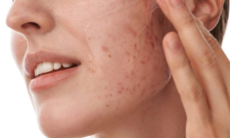 Acne Removal 800x480px