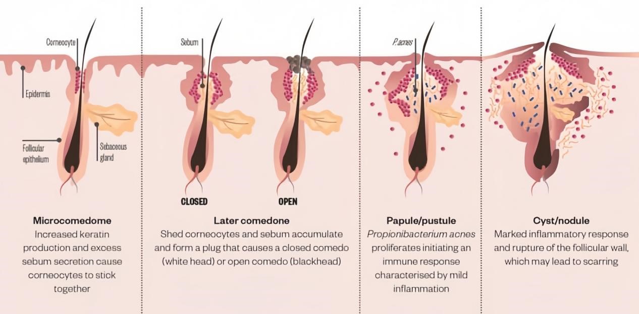 Types of Scar