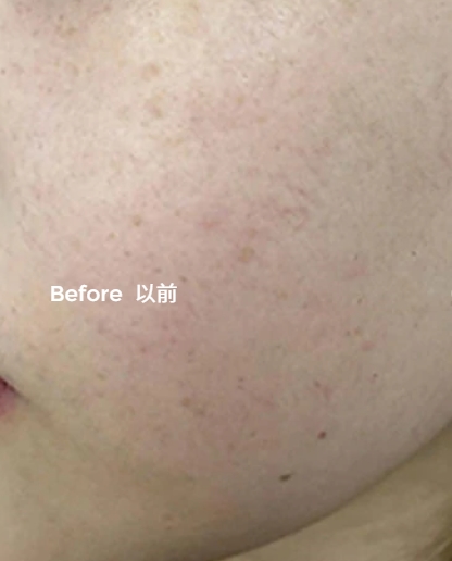 Freckle removal treatment (1h after treatment)